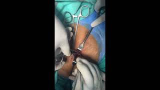 Peritoneal Catheter insertion by open technique Part II [upl. by Aihseken]