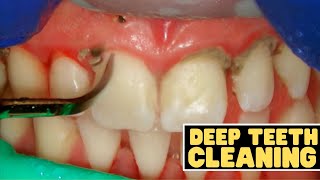 Teeth Cleaning vs Deep Cleaning  Dentist Reviews How Teeth Are Cleaned [upl. by Chap109]