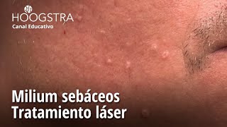 Milium sebáceos  Tratamiento láser  23094 [upl. by Eimat]