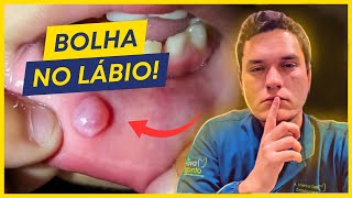 Herpes labial  Como previnir e tratar [upl. by Yevrah]