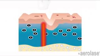 how aerolase works [upl. by Hobard]