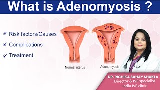 What is Adenomyosis Treatments Symptoms and Causes Dr Richika Sahay Shukla  India IVF Clinic [upl. by Kevin]