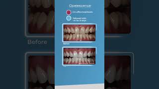 Opalescence™ Boost™ and Opalescence™ PF  Case Study [upl. by Way]