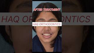 Braces before and after treatment dentist dentaltreatment bracescost orthodontist dentalsmile [upl. by Nahtnhoj]