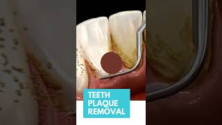 Teeth tartar cleaning  Health Go [upl. by Ettevahs416]