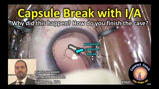 posterior capsule break during IA in cataract surgery [upl. by Rempe]