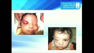 Update in Orbital and Periorbital and Hemangiomas and Vascular Malformation [upl. by Elma]