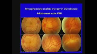 Mycophenolate mofetil therapy in VogtkoyanagiHarada disease [upl. by Nivag722]