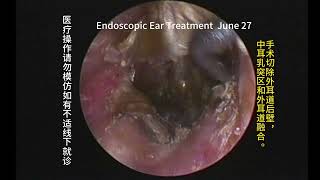 Follow up cleaning after 20 years of cholesteatoma surgery [upl. by Anuayek]