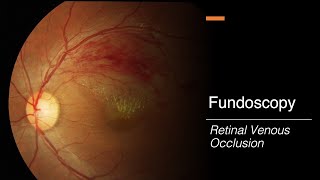 Retinal Venous Occlusion Fundoscopy [upl. by Germaun]