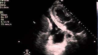 Pleural Effusion versus Pericardial Effusion on Ultrasound Imaging [upl. by Devinne]