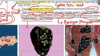 Biliary Atresia Cholelithiasis from first aid step 1USMLEUrduHindi [upl. by Dlanod]