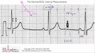 Interval Measurements 64  ECG  EKG Interpretation  BASIC [upl. by Eldredge]