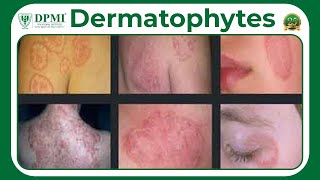 Dermatophyte Infection Types Of Dermatophytes Dermatophyte Symptoms Diagnosis And Treatment [upl. by Eylatan]