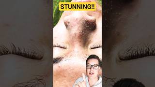 ULTIMATE PORE STRIP REMOVAL  How To Prep Skin For Pore Strips shorts [upl. by Lateh]