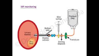 What is IntraAbdominal Pressure A review of the physiology [upl. by Akinehc]