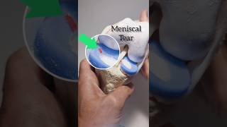 Meniscal tear knee model [upl. by Adaiha]