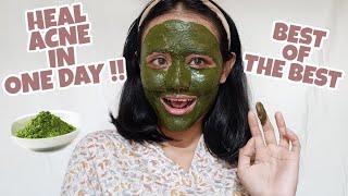 5 DAYS MATCHA GREEN TEA MASK ON ACNE PRONE SKIN  English [upl. by Afra999]