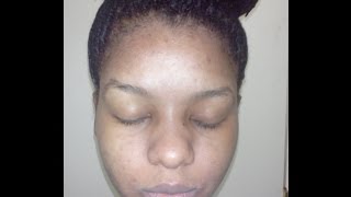 How kojic acid soap changed my face week 4 before and after pictures [upl. by Armilda]