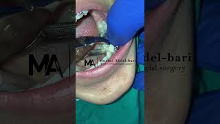 extraction of malposed lower second premolar using forceps [upl. by Hazeghi442]