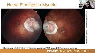 Lecture Glaucoma in the Myopic Eye [upl. by Hsu]