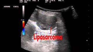 Liposarcoma [upl. by Iderf]