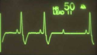 2nd Degree Type II Heart Block  ECG Training [upl. by Brogle]