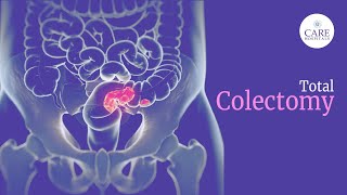 What is Laparoscopic Total Colectomy and How is Total Colectomy Done  CARE Hospitals [upl. by Nadaha]