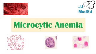 Microcytic Anemia amp Causes Iron Deficiency Thalassemia Anemia of Chronic Disease Lead Poisoning [upl. by Hump]