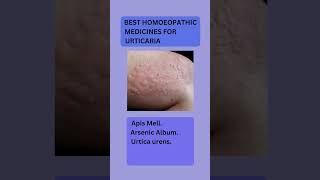 urtica urens homeopathic medicine usesurticaria treatmenturticaria medical homoeopathyurticaria [upl. by Yrro466]