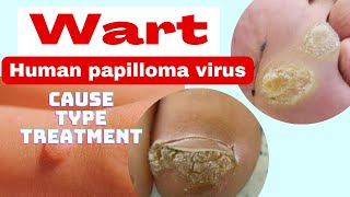 wart  मस्सा   cause type treatment  nursing class in hindi  human papilloma virus [upl. by Elagibba]