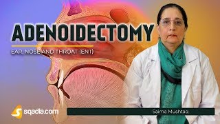 Adenoidectomy  Indications  ENT Video Lectures  Medical Education  VLearning [upl. by Reinwald]