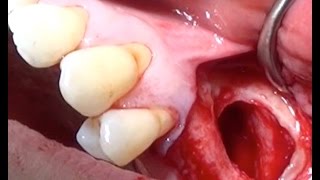 Maxillary Sinus liftSurgical Video [upl. by Tloc]