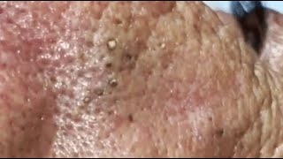 WOOW  A PILE OF BLACKHEADS IN THE NOSE OF AN ELDERLY MAN😨 relaxing blackheads [upl. by Einon8]