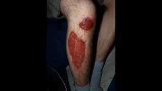 Leg Abrasion Healing Process [upl. by Orag]