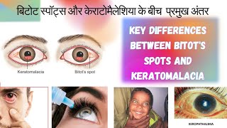 बिटोट स्पॉट्स और केराटोमैलेशिया के बीच अंतरdifferences between Bitots Spots and Keratomalacia [upl. by Howlan]