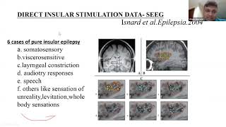 Stereo EEG in surgical epileptology [upl. by Midge]