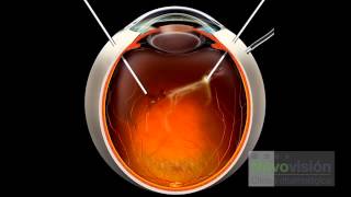 ¿EN QUÉ CONSISTE LA VITRECTOMÍA  CLÍNICAS NOVOVISIÓN [upl. by Hamon]