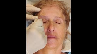 Brow Thread Lift by Dr Hopping at The Center for Cosmetic Surgery in Washington DC [upl. by Ydnem]