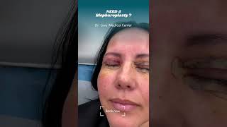 Blepharoplasty surgery eyelid  Doctor Levy Romania plastic surgeon [upl. by Marilee331]