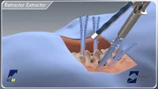 EVEREST® Minimally Invasive Surgical Technique Animation [upl. by Evans]