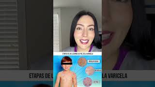 La culebrilla también conocida como herpes zóster [upl. by Genia]