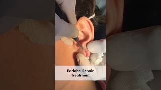 Earlobe Repair Treatment at Skinaa Clinic  Viral shorts earloop [upl. by Llenod]