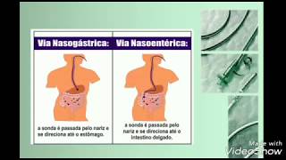 Passagem de SNE Sonda Nasoenteral  Sondagem Nasoenterica [upl. by Alfy]