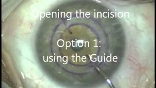 Corneal Ring Surgerywmv [upl. by Nosidda582]