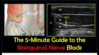 Ilioinguinal Nerve Block  A HowTo Guide [upl. by Leola]