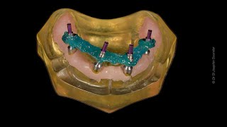 StepbyStep Allon4 Impression Techinique allonX allon4 allon6 fullmouth zygomaticimplants [upl. by Branca]