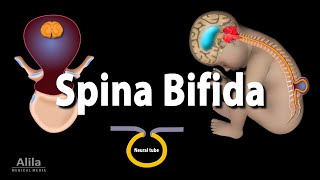 Spina Bifida Animation [upl. by Merdith]