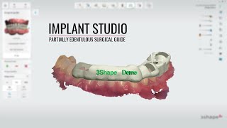 3shape Implant Studio Partially Edentulous [upl. by Sindee]