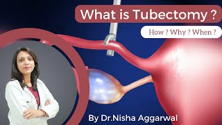 What Is Tubectomy  By DrNisha Aggarwal  How  Why  When   Female Sterilisation [upl. by Gae190]